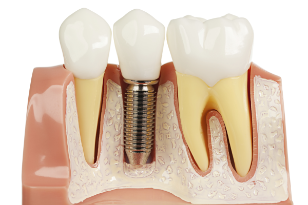 Dental Bone Graft and Substitutes Market